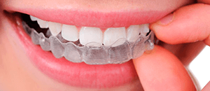 Can Invisalign Work for you